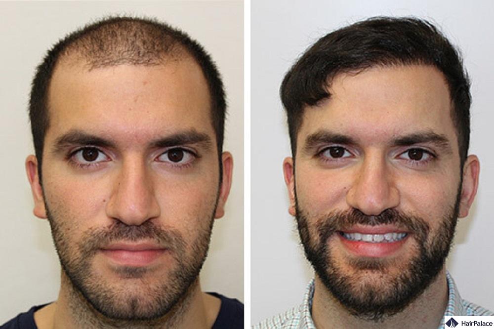 Top hair clinics in Canada